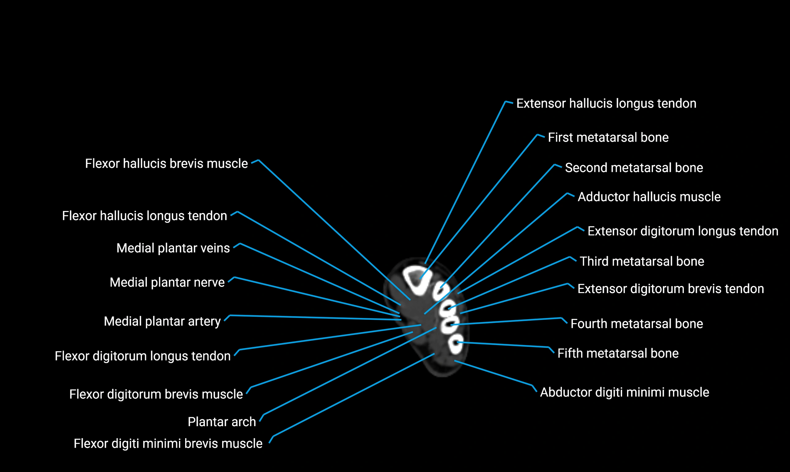 CT lower limb axial cross sectional anatomy labelled image 185 (2).webp